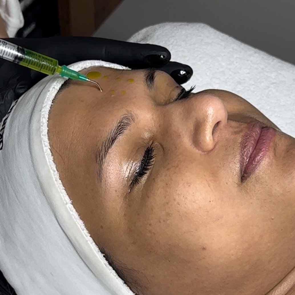 A practitioner applying a peel solution to a client’s forehead