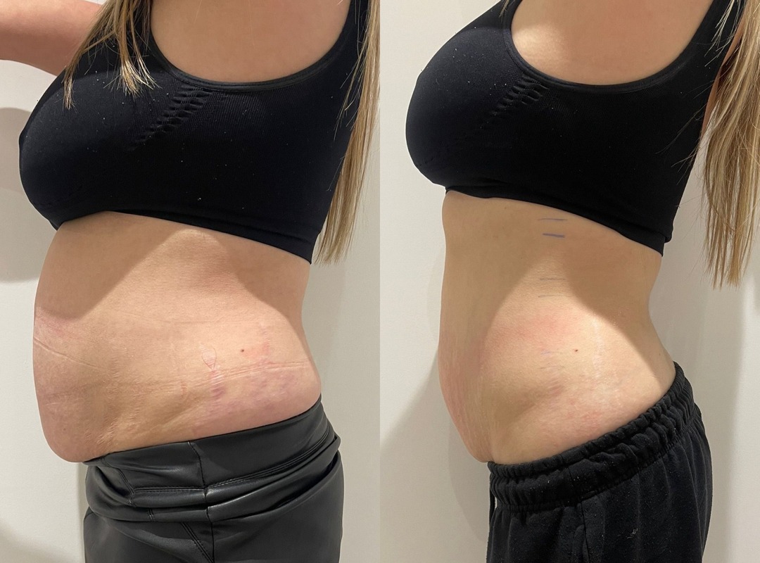 Before and after body contouring, side view of the tummy