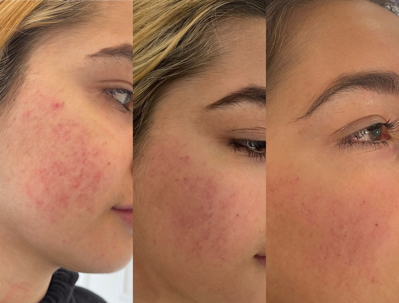 The same cheek at three stages, from red, inflamed breakouts to calmer, clearer skin