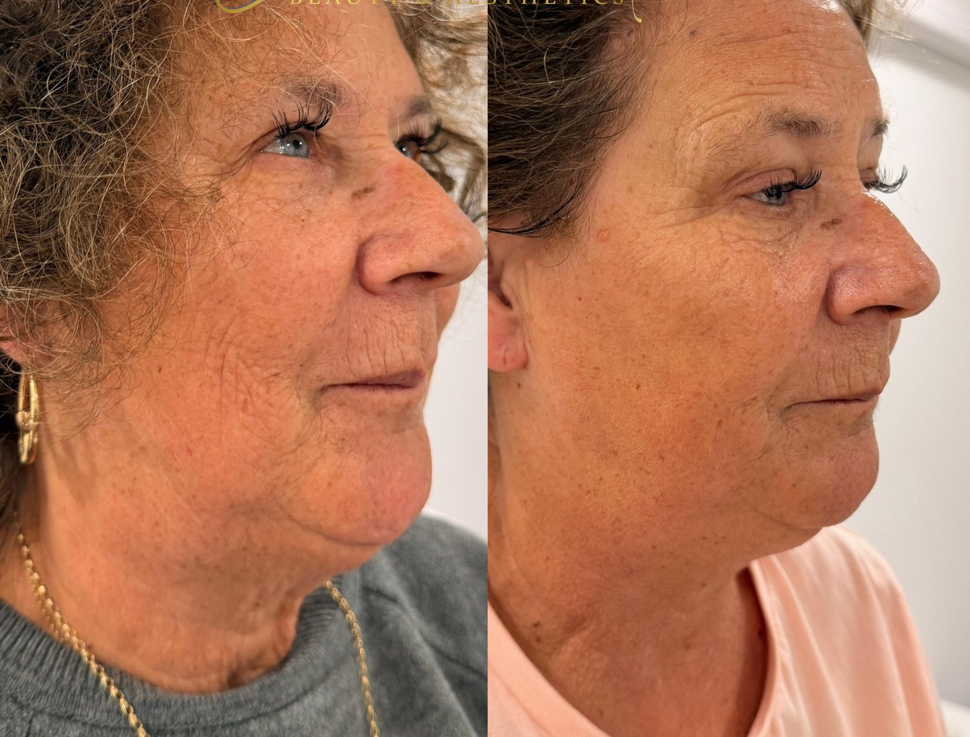 Three-quarter profile of a client before and after BTL Exion Face, with a firmer-looking jowl and jawline in the after