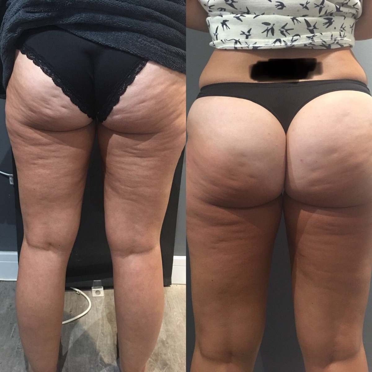 Before and after the LipoFirm buttock lift, back view