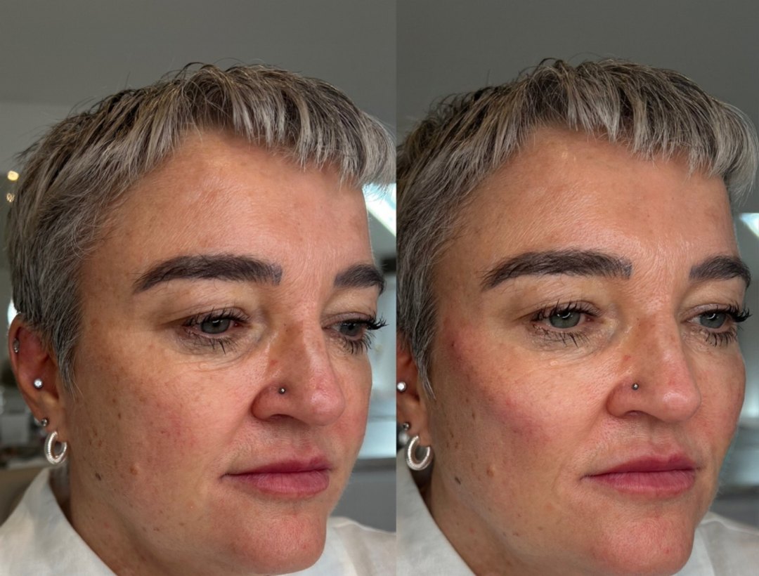 Three-quarter view of a client before and after cheek filler