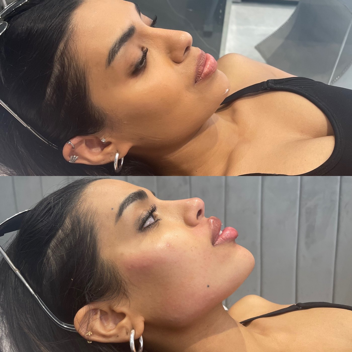Profile before and after chin, jawline and lip filler, with a more defined chin and jawline in the after