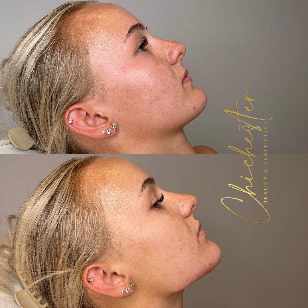 Profile before and after chin and jawline balancing, with a more defined chin in the after