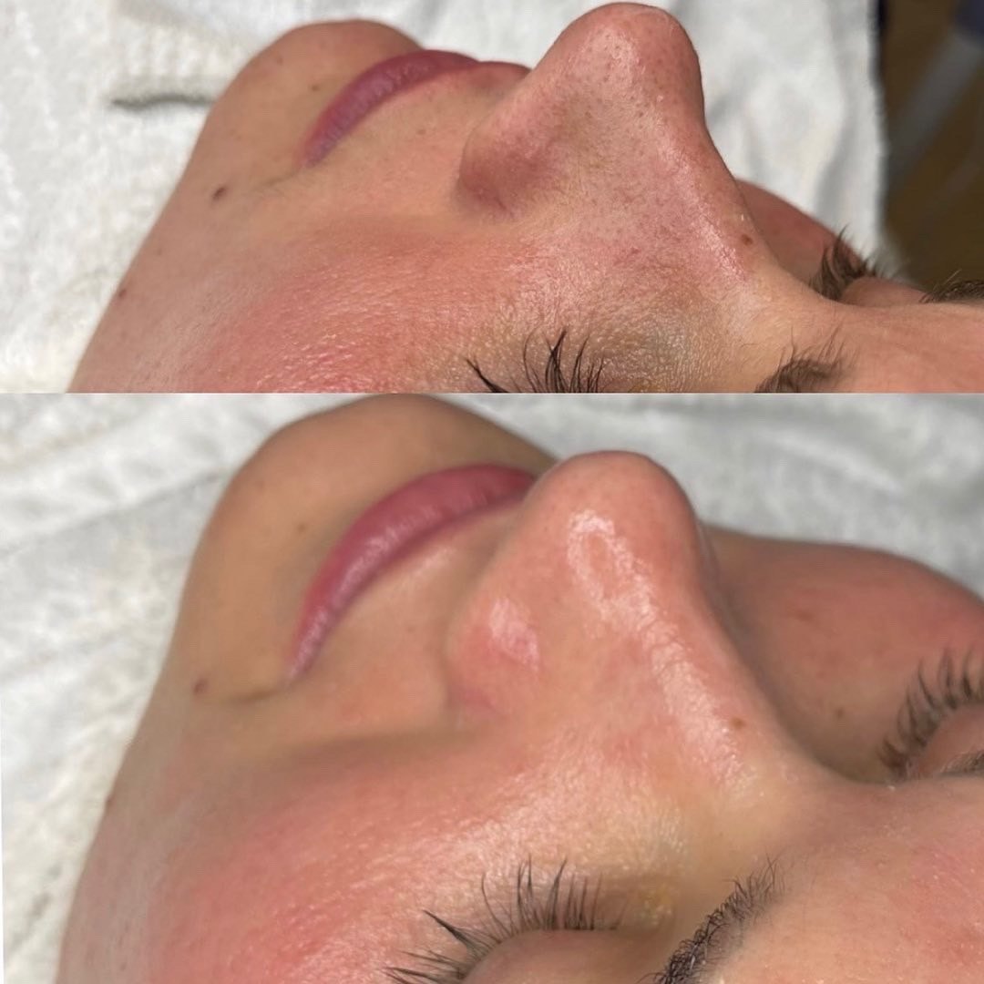 Nose and cheek before and after a deep cleansing facial, with clearer pores in the after