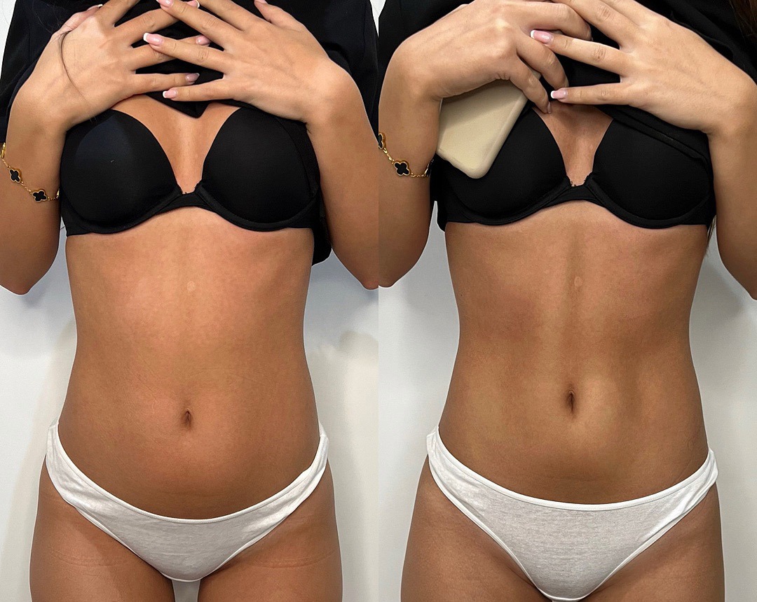 Before and after BTL EMSCULPT®, front view of the tummy