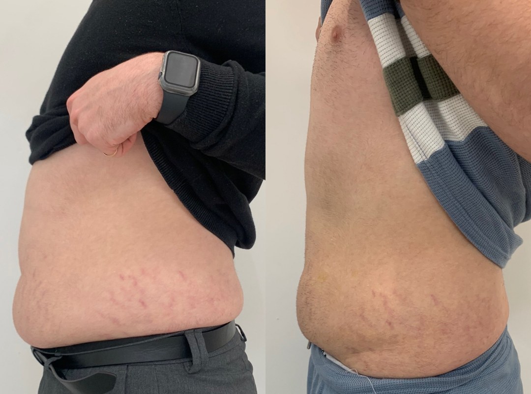 Side view of a male abdomen before and after fat dissolving, with a smaller lower-belly bulge in the after