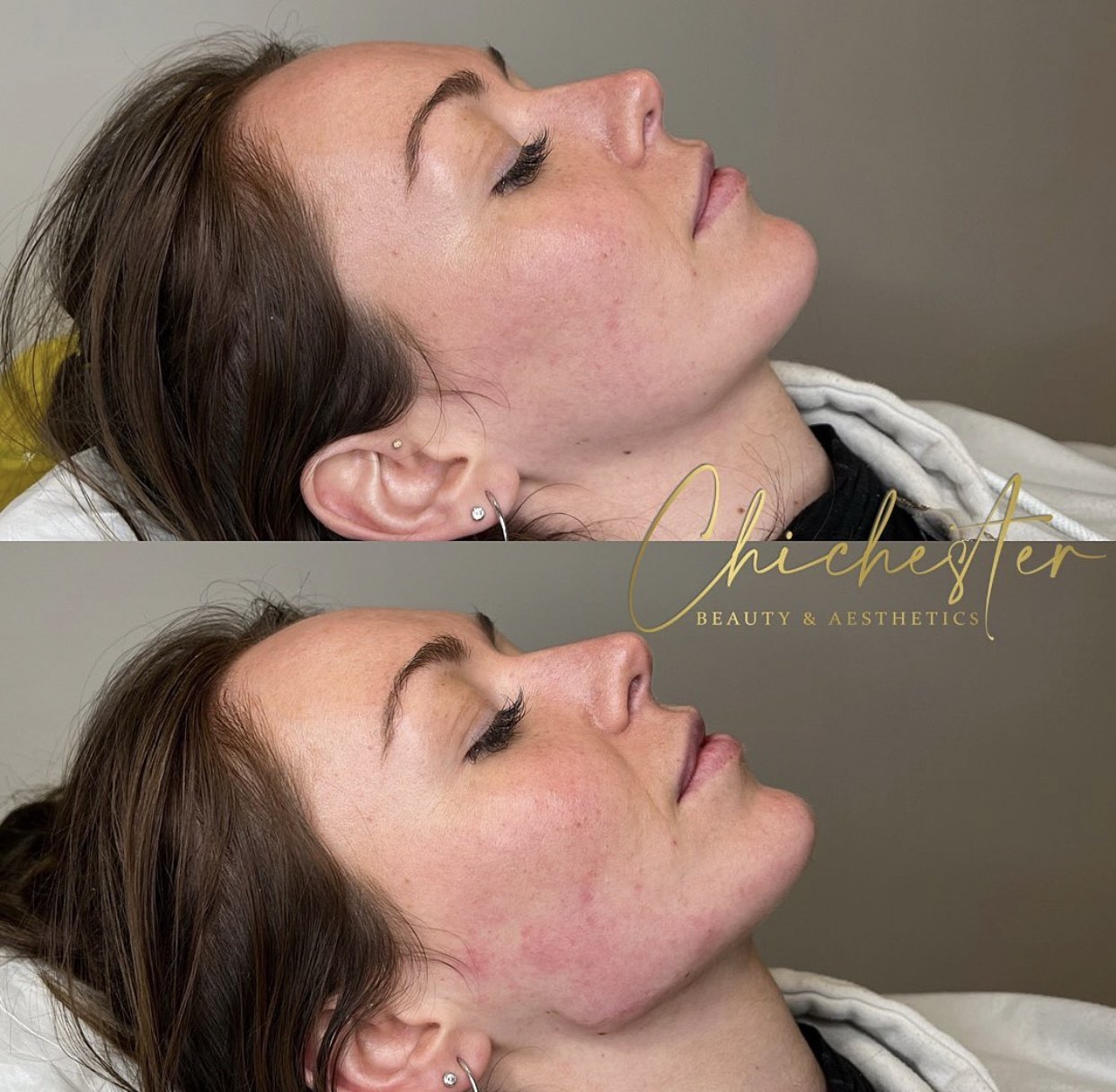 Profile before and after jawline and chin filler, with a more defined jawline in the after