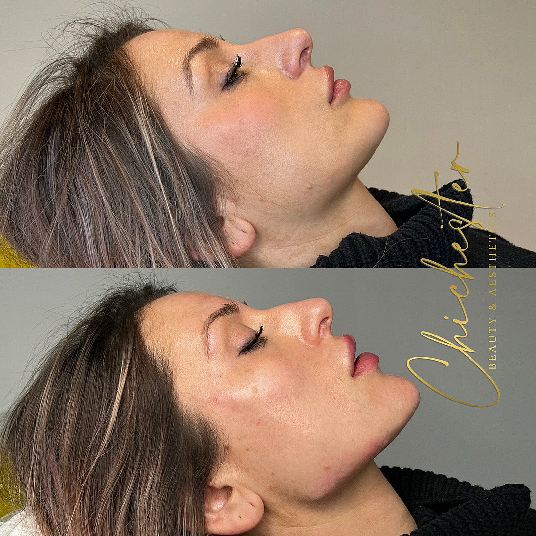 Profile before and after jawline and chin filler, with a sharper jawline and chin in the after