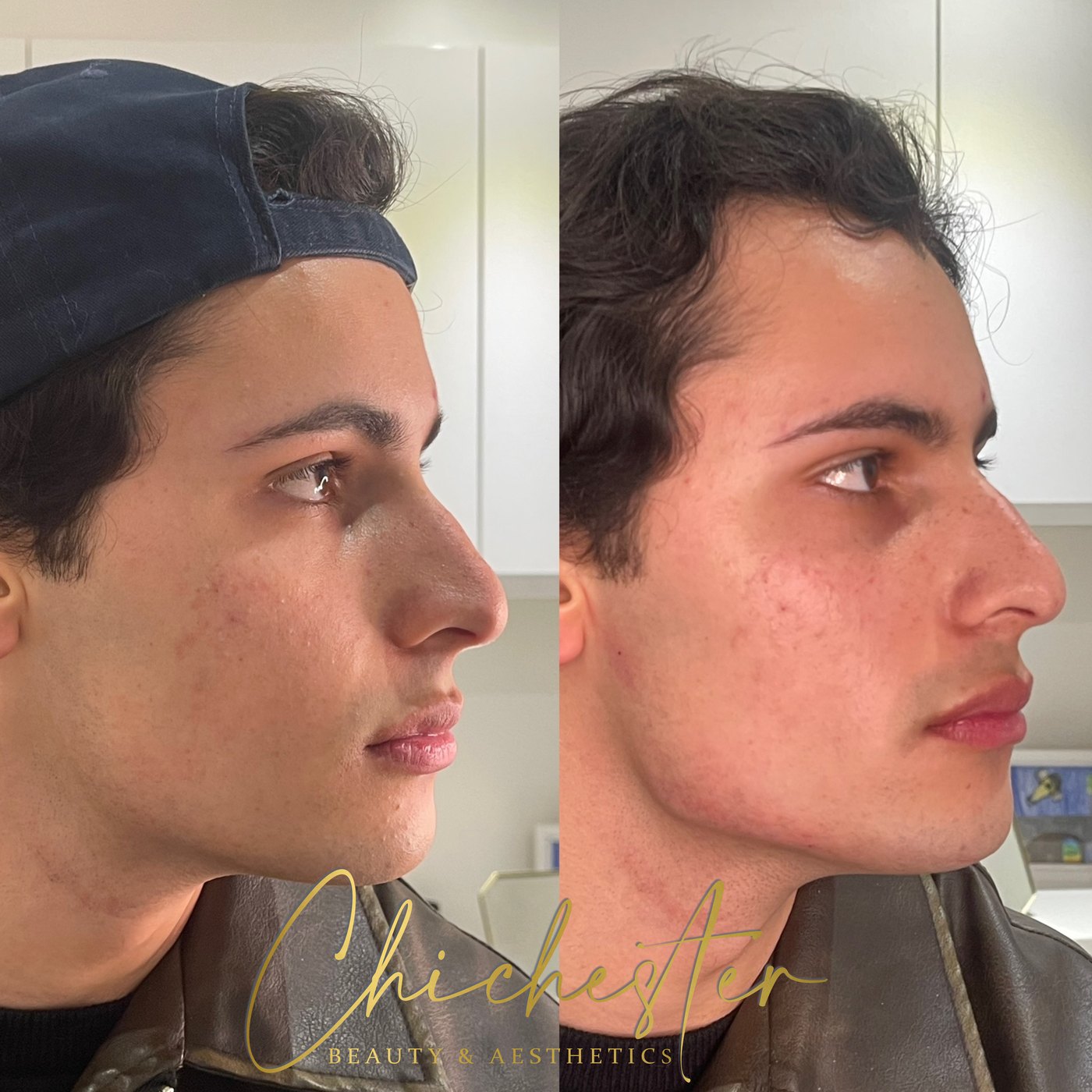 Male profile before and after jawline and chin filler, with a sharper jaw and more chin projection in the after