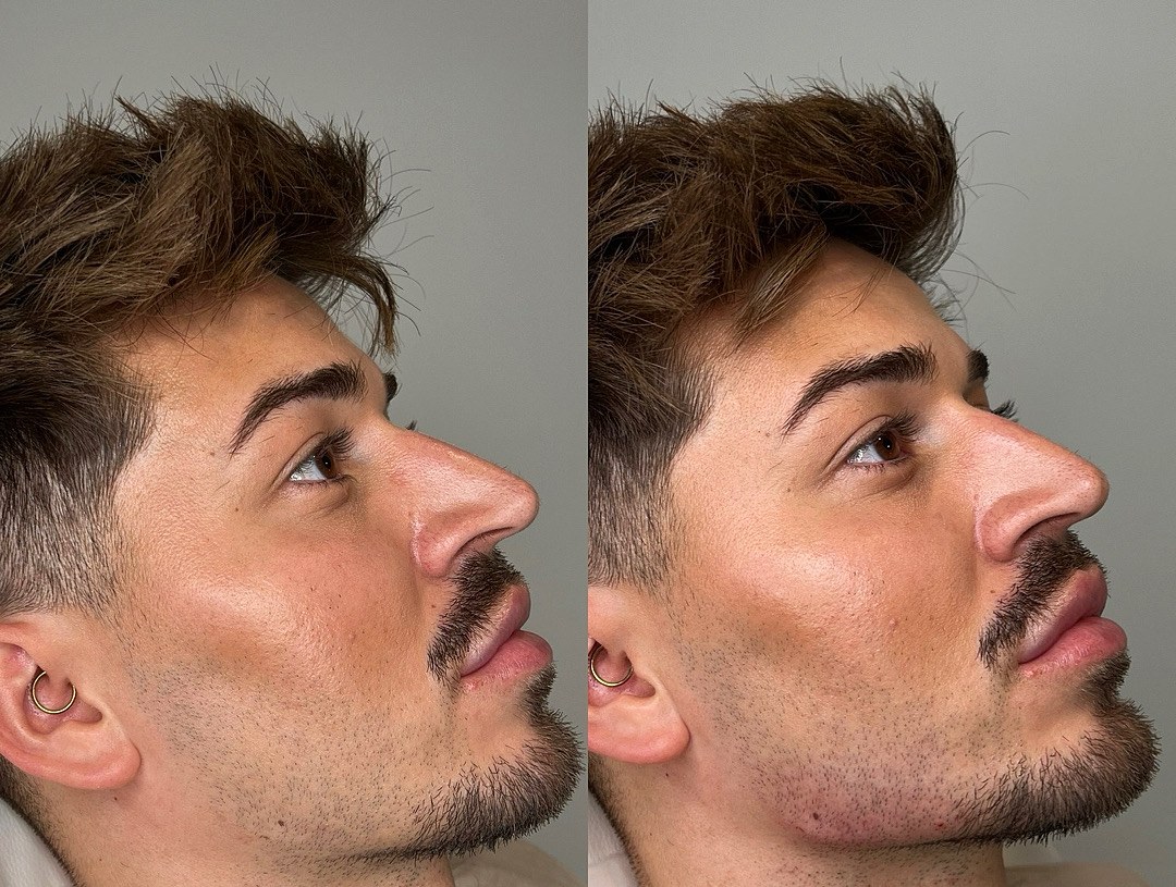 Male profile before and straight after jawline filler, with a sharper jaw angle in the after