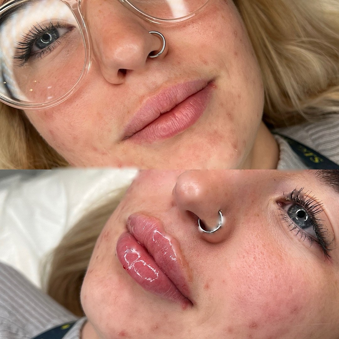 Before and after lip filler