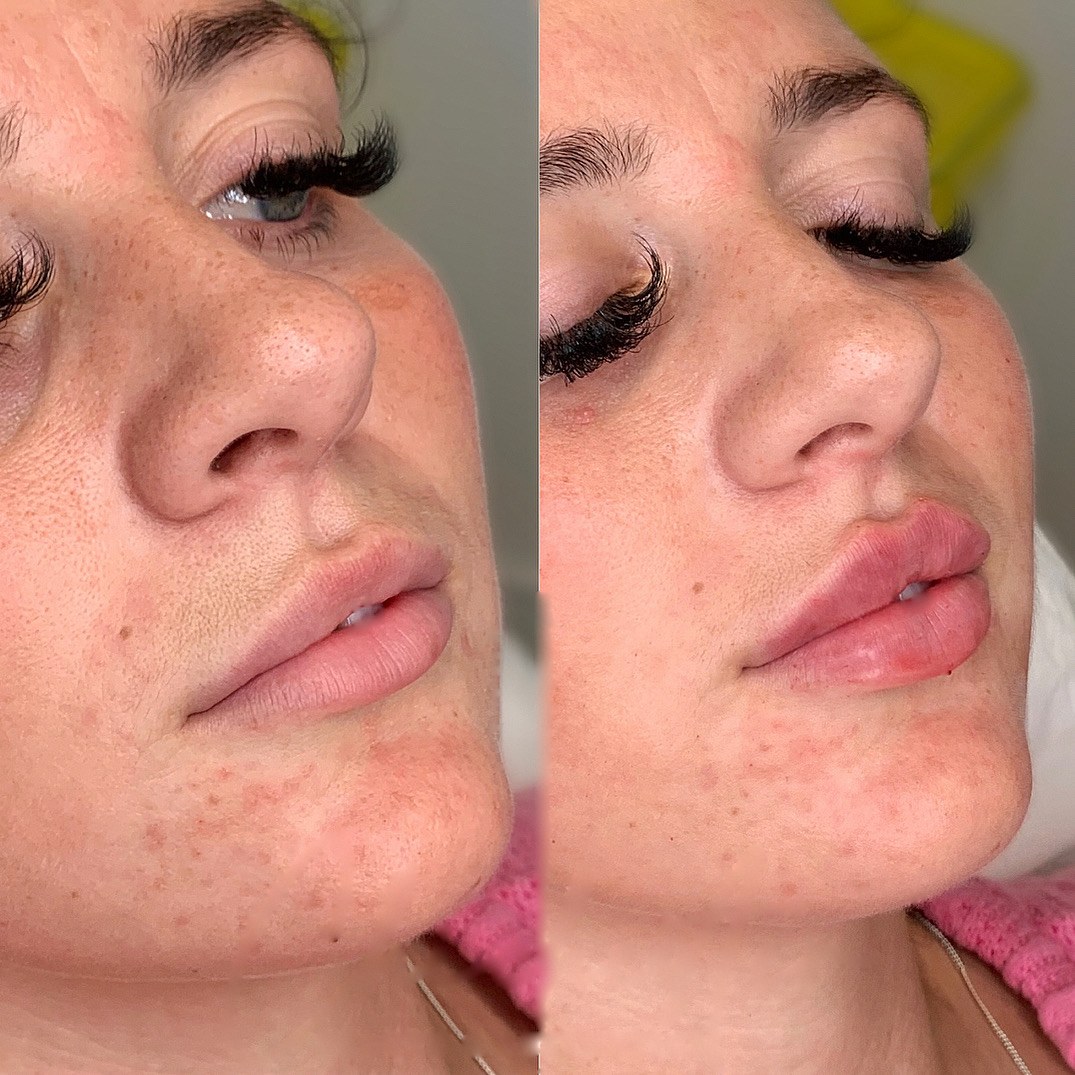 Before and after lip filler, three-quarter view