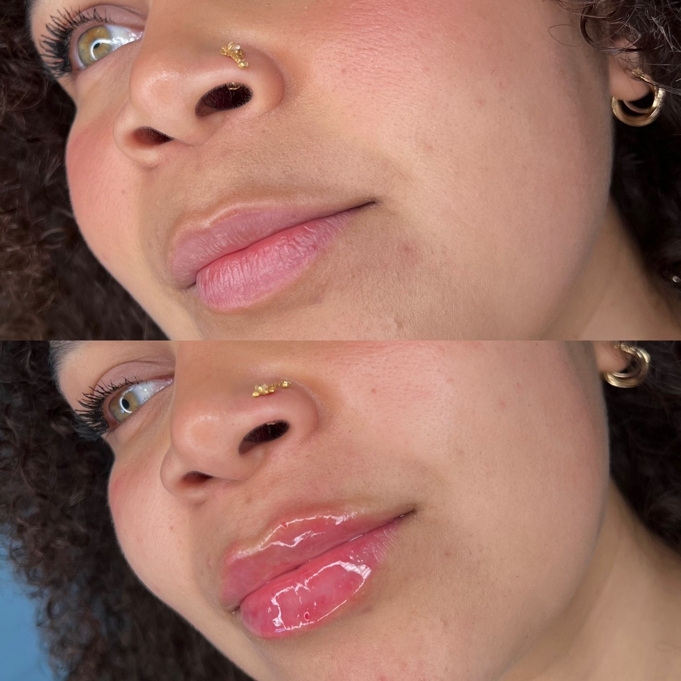 Lips before and straight after lip filler, three-quarter view from below