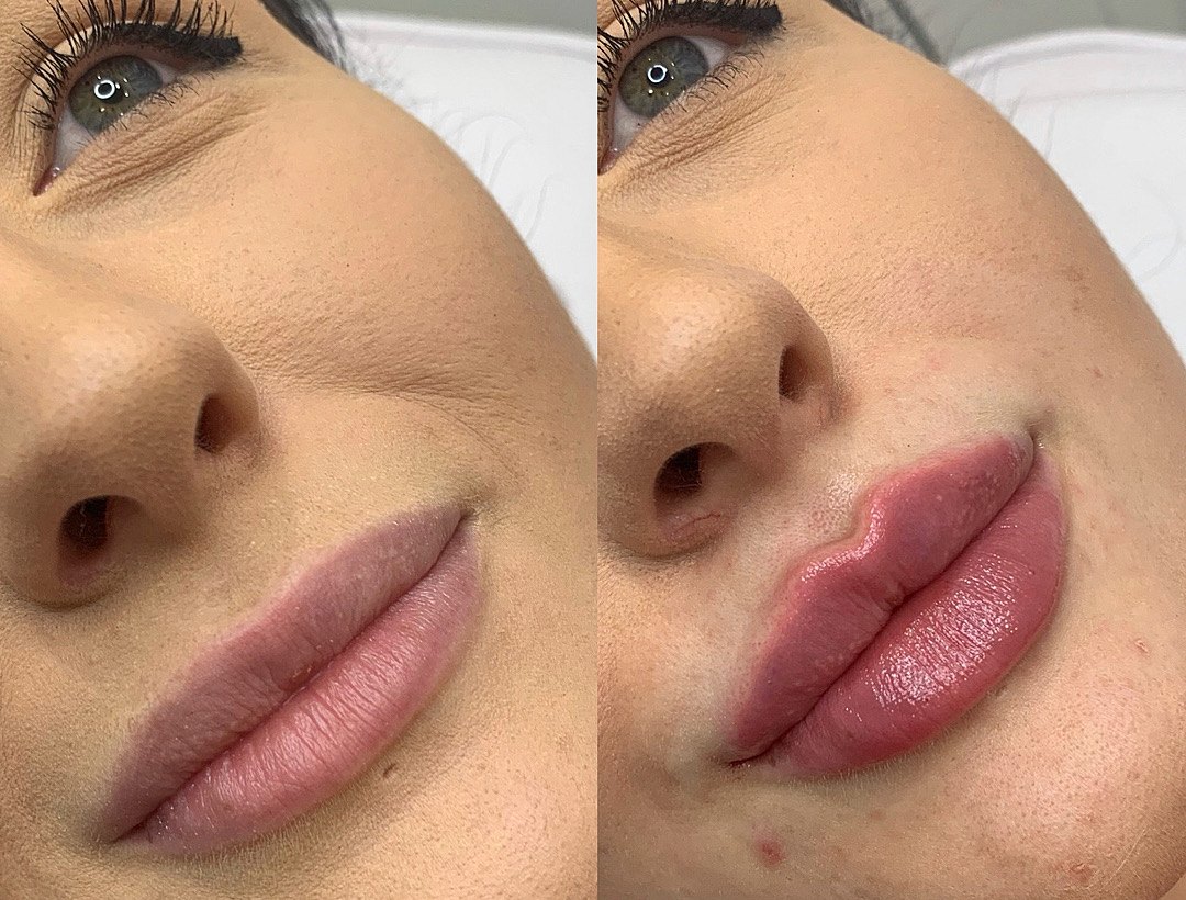 Lips before and after lip filler, side by side, with a more defined cupid’s bow in the after