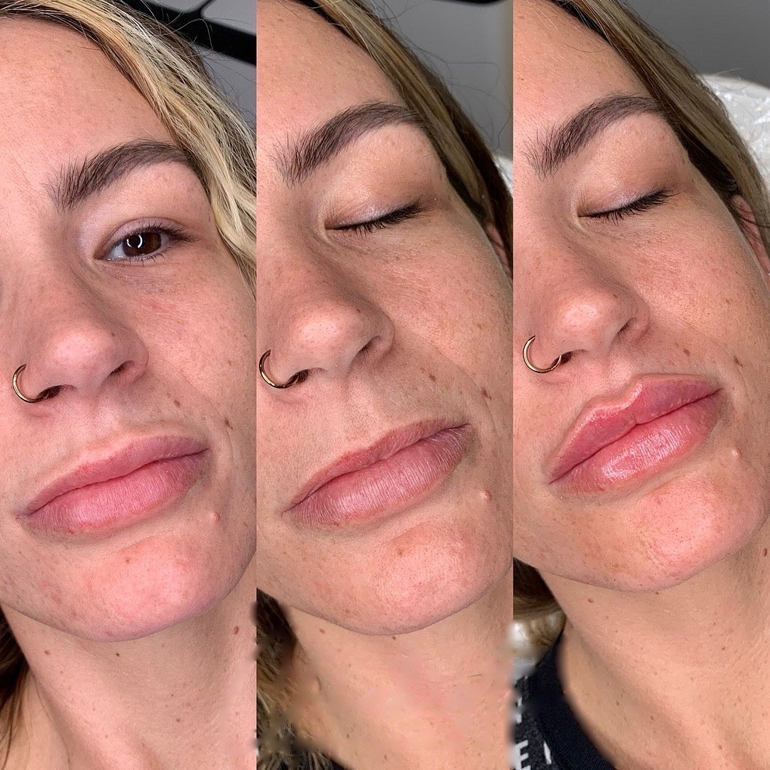 Lips before, after dissolving and after new filler