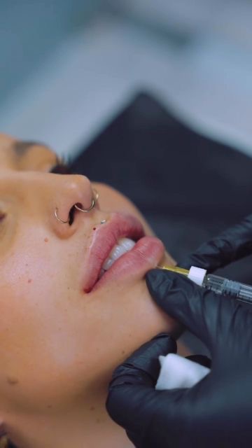Lip filler being carried out in clinic