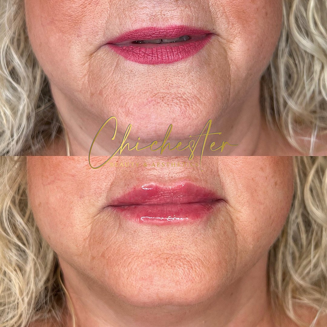 Mature lips before and after lip filler, front view