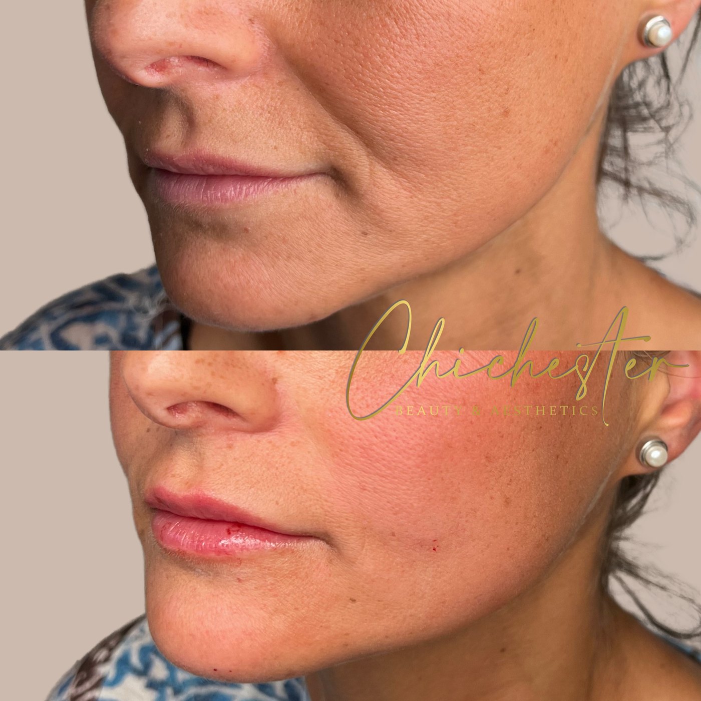 Lower face before and after lip and lower face filler, three-quarter view