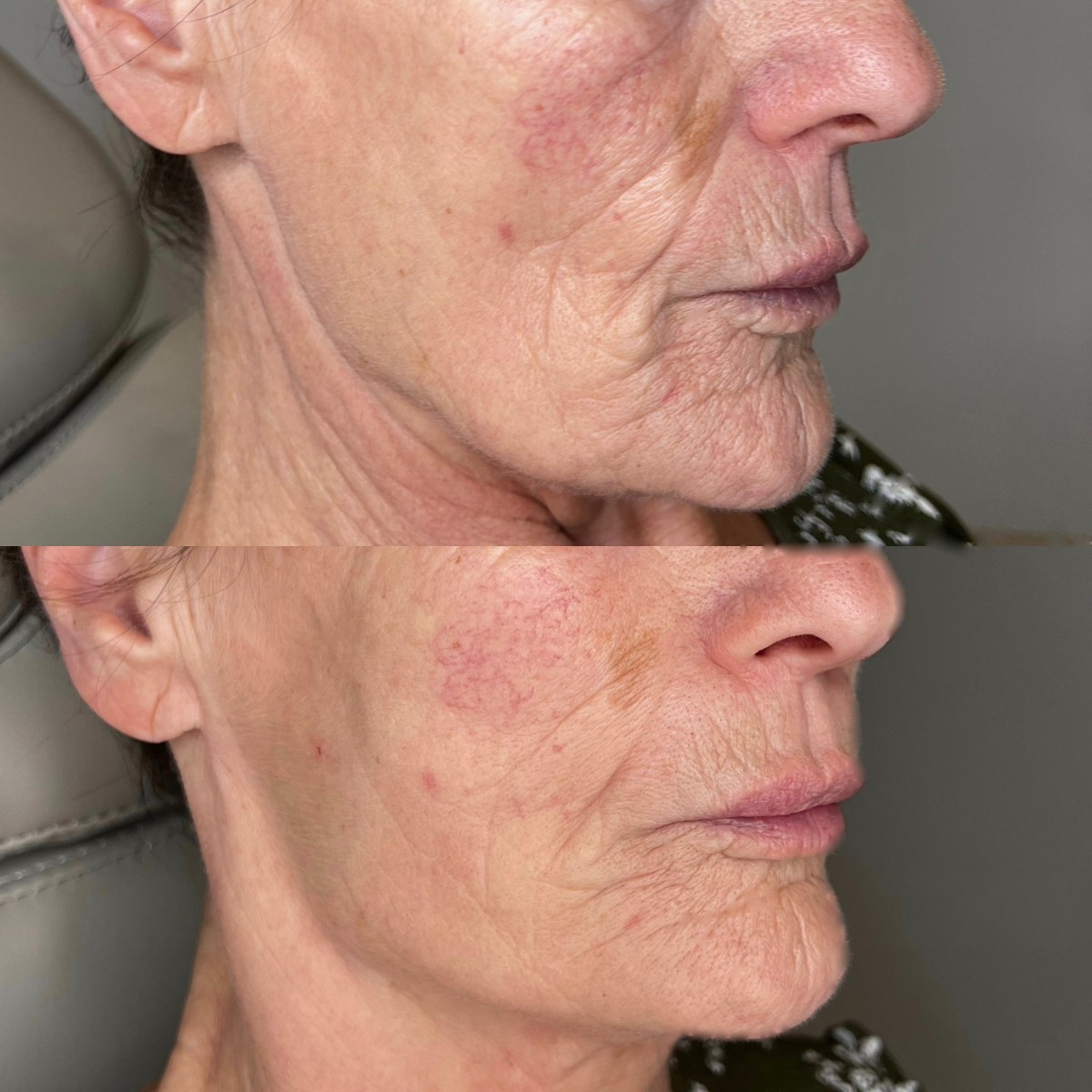 Before and after lower face and jawline treatment, side view