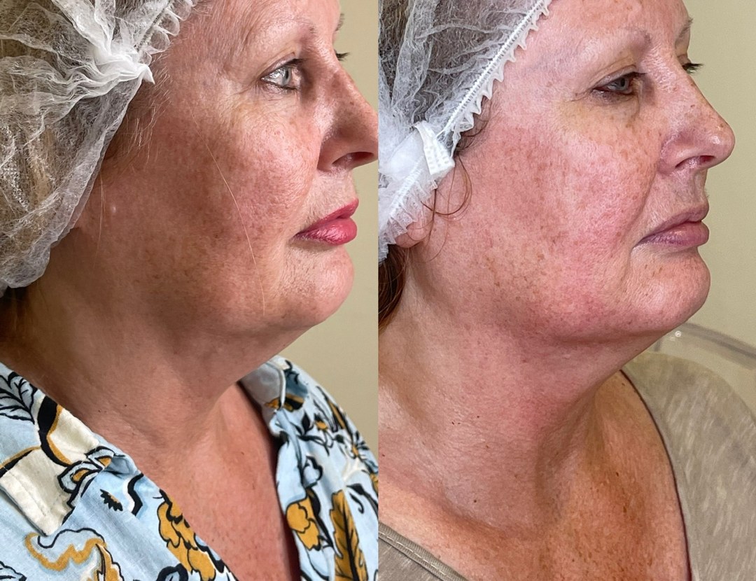 Three-quarter profile of a client before and after a course of LP Facelift treatments, with a firmer-looking jawline in the after