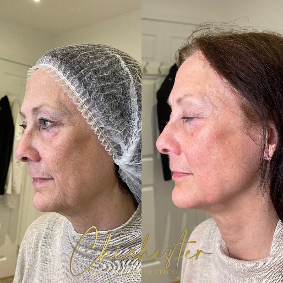 Side profile of a mature client before and after a course of LP Facelift treatments, with a lifted look to the jaw and cheek in the after