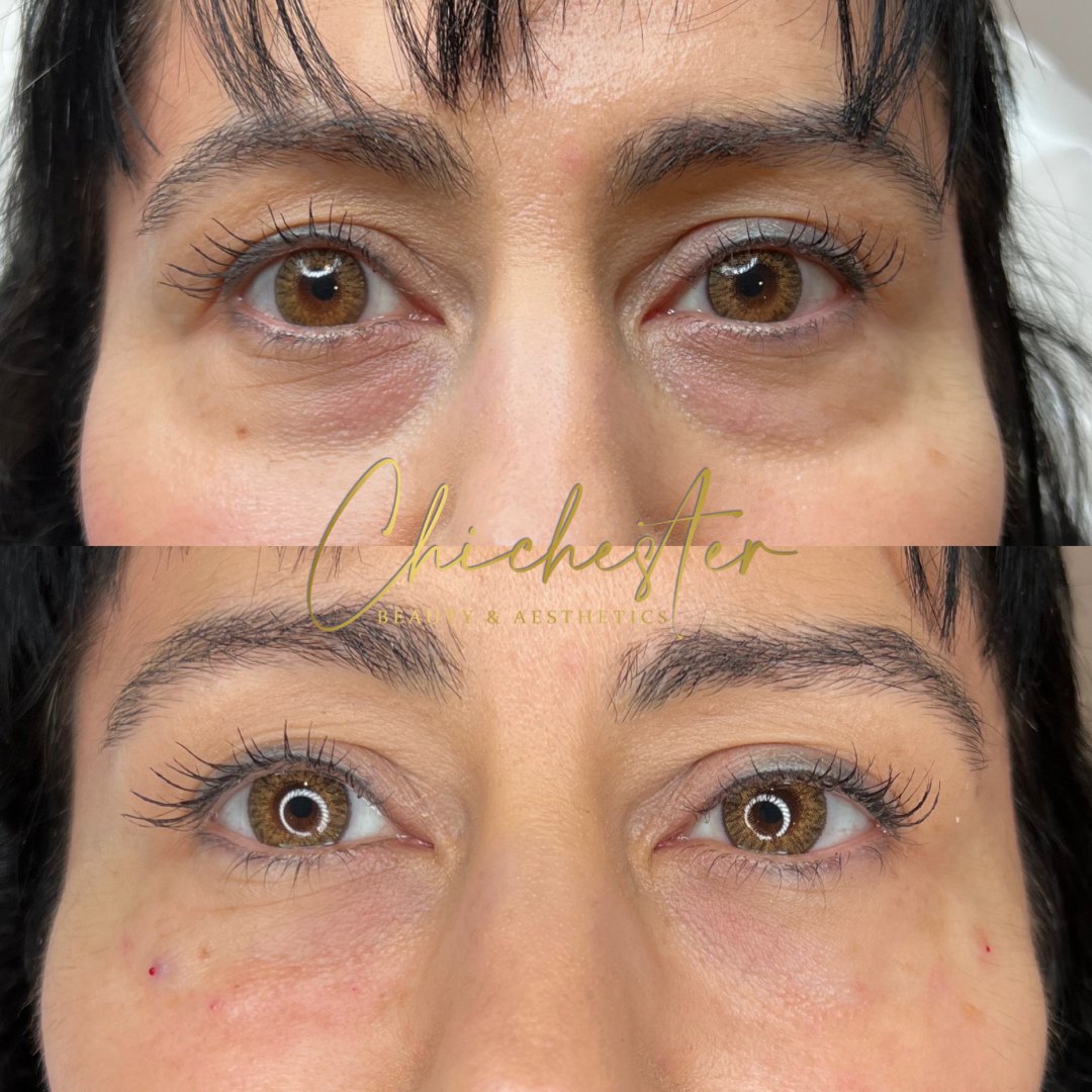 Under-eye area before and after Lumi Eyes, with brighter, less shadowed skin under the eyes in the after