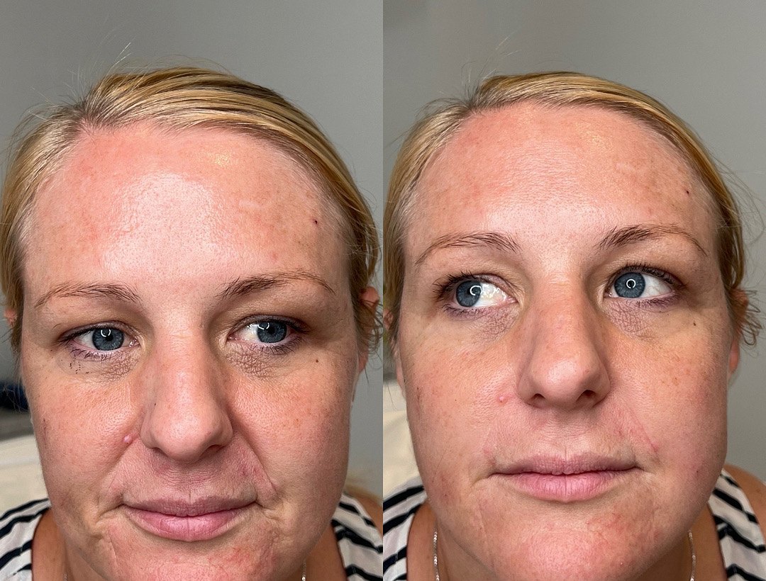 Front view before and after nasolabial fold filler, with softer lines from nose to mouth in the after