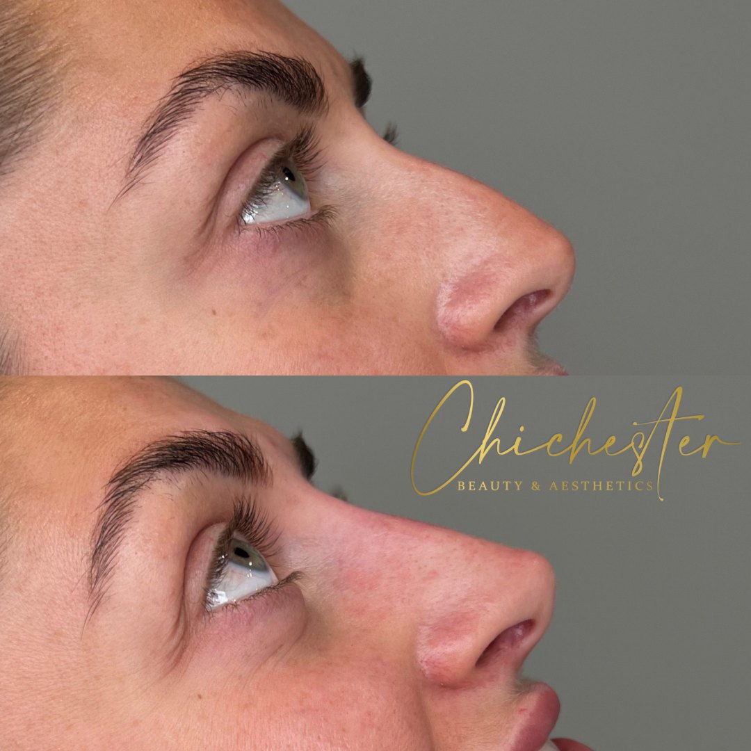 Nose in profile before and after non-surgical rhinoplasty, with a smoother, straighter bridge in the after