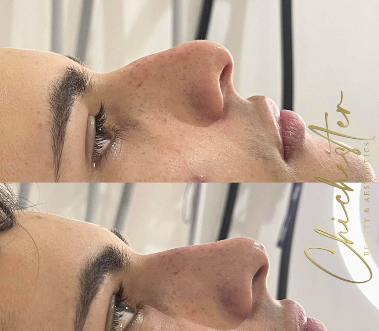 Male nose in profile before and after non-surgical rhinoplasty, with a straighter bridge in the after