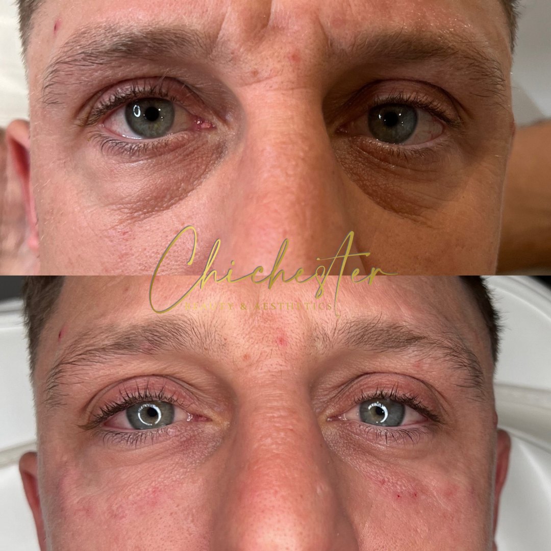 Male client under-eye area before and after polynucleotides, with smoother-looking skin under the eyes in the after