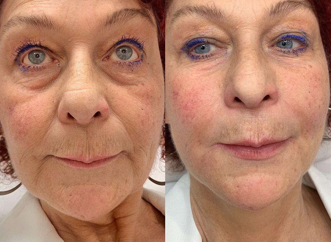 Front view before and after PRP skin rejuvenation, with brighter, smoother skin in the after