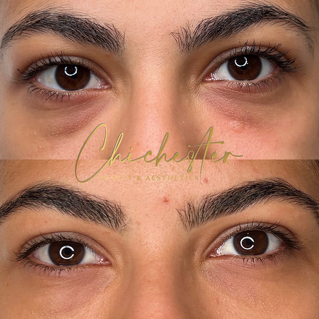Eyes before and after tear trough filler, with a smoother under-eye area in the after