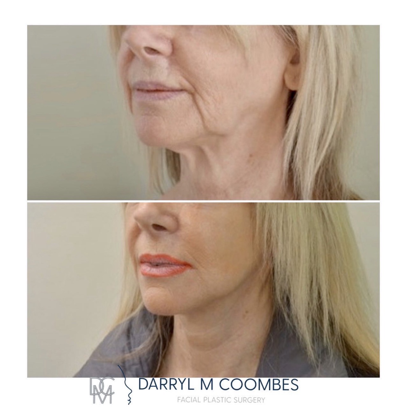 Lower face and neck before and after an Apex Facelift®