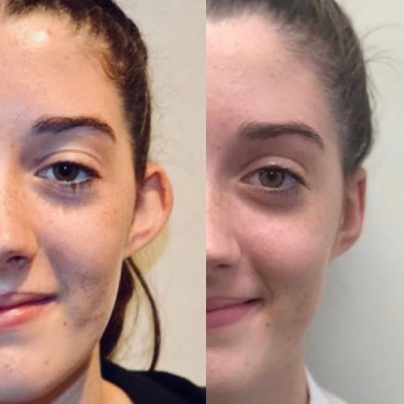 Before and after otoplasty with Mr Darryl Coombes, three-quarter view