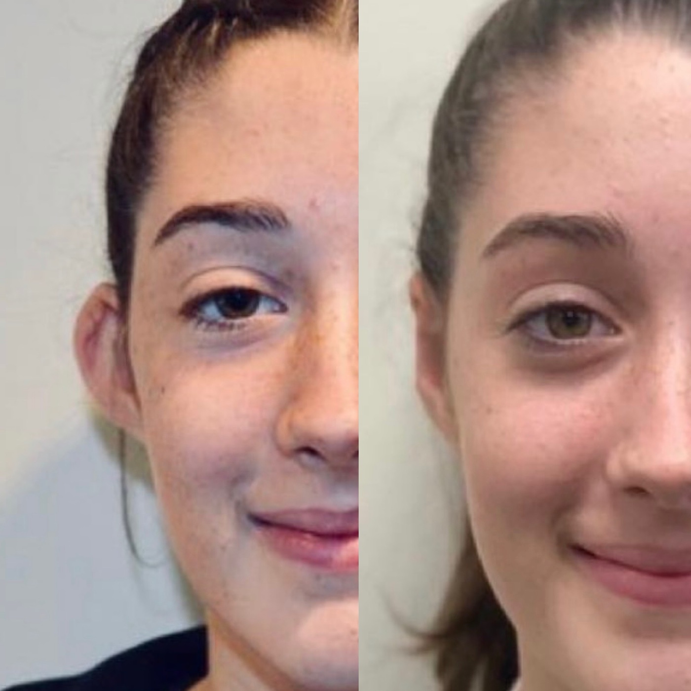 Before and after otoplasty with Mr Darryl Coombes, front view